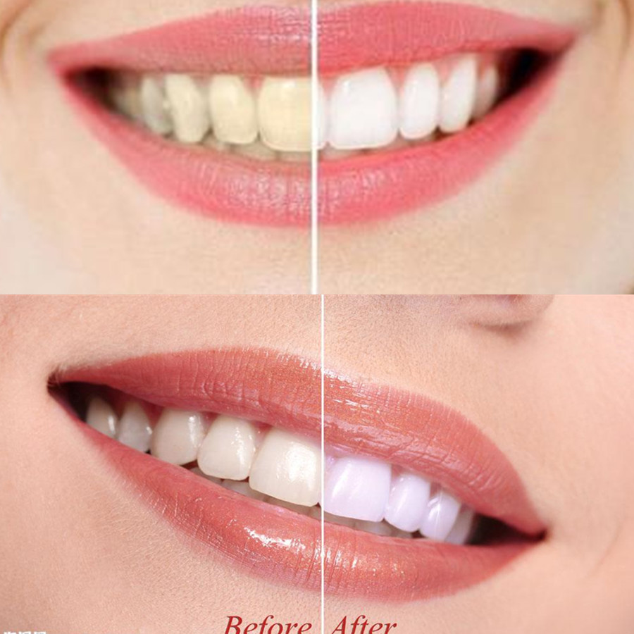 Than Tre Răng Răng Nha Khoa De - đánh giá và giá Teeth Whitening Quotes