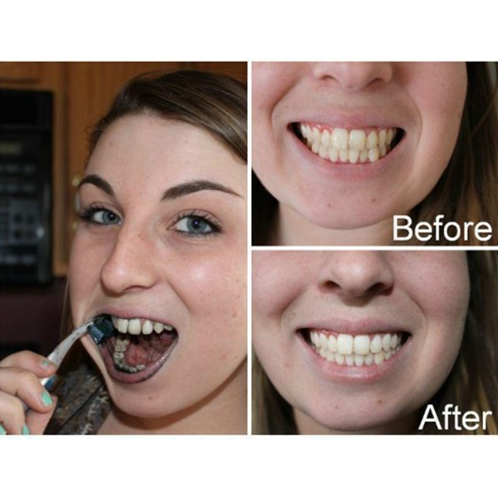 Than Tre Răng Răng Nha Khoa De - đánh giá và giá Teeth Whitening Quotes